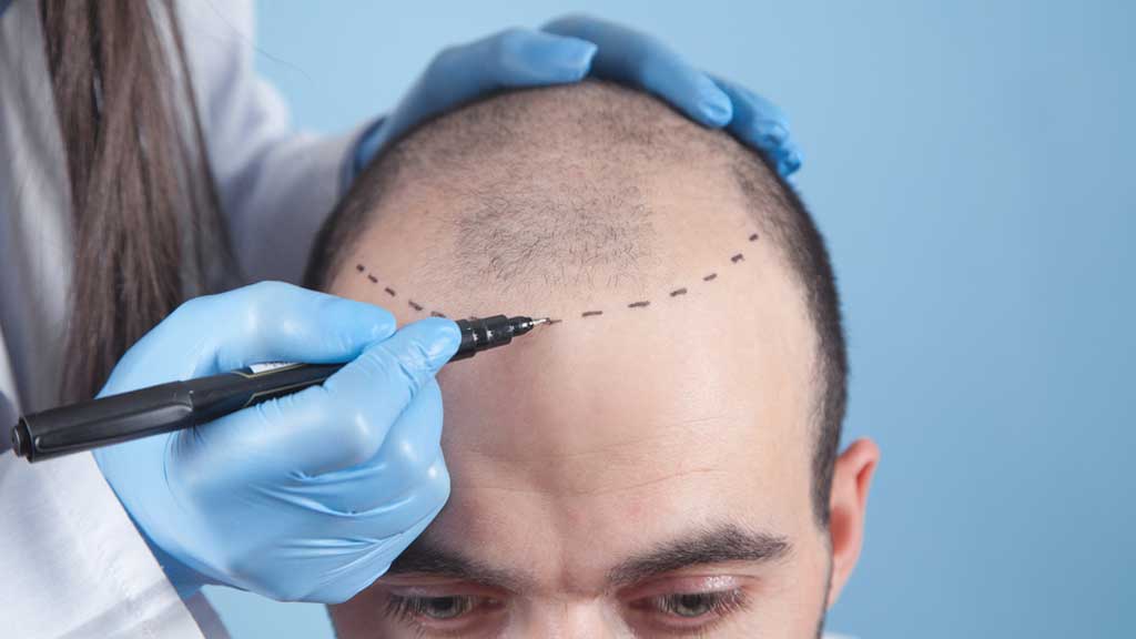 معرفی ۱۰ کلینیک کاشت مو معتبر در شیراز