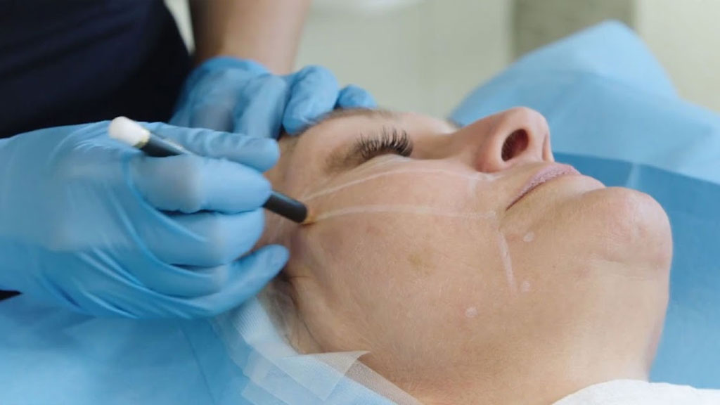 معرفی ۱۰ تا از بهترین دکتر لیفت با نخ در شیراز