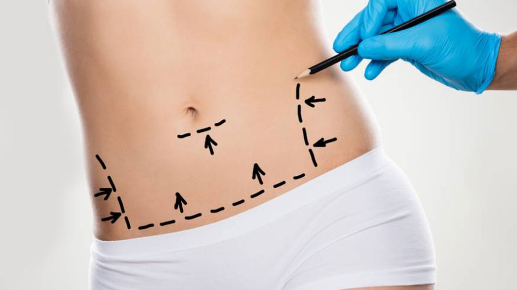 معرفی ۱۰ دکتر معتبر جراحی ابدومینوپلاستی در شیراز