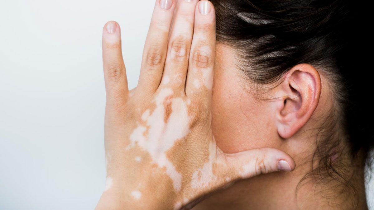 معرفی ۱۰ دکتر برتر درمان قطعی پیسی در شیراز