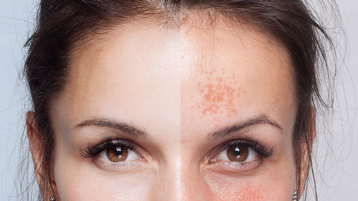 درمان لک صورت در شیراز