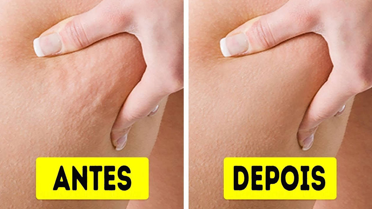 بهترین دکتر درمان سلولیت در شیراز